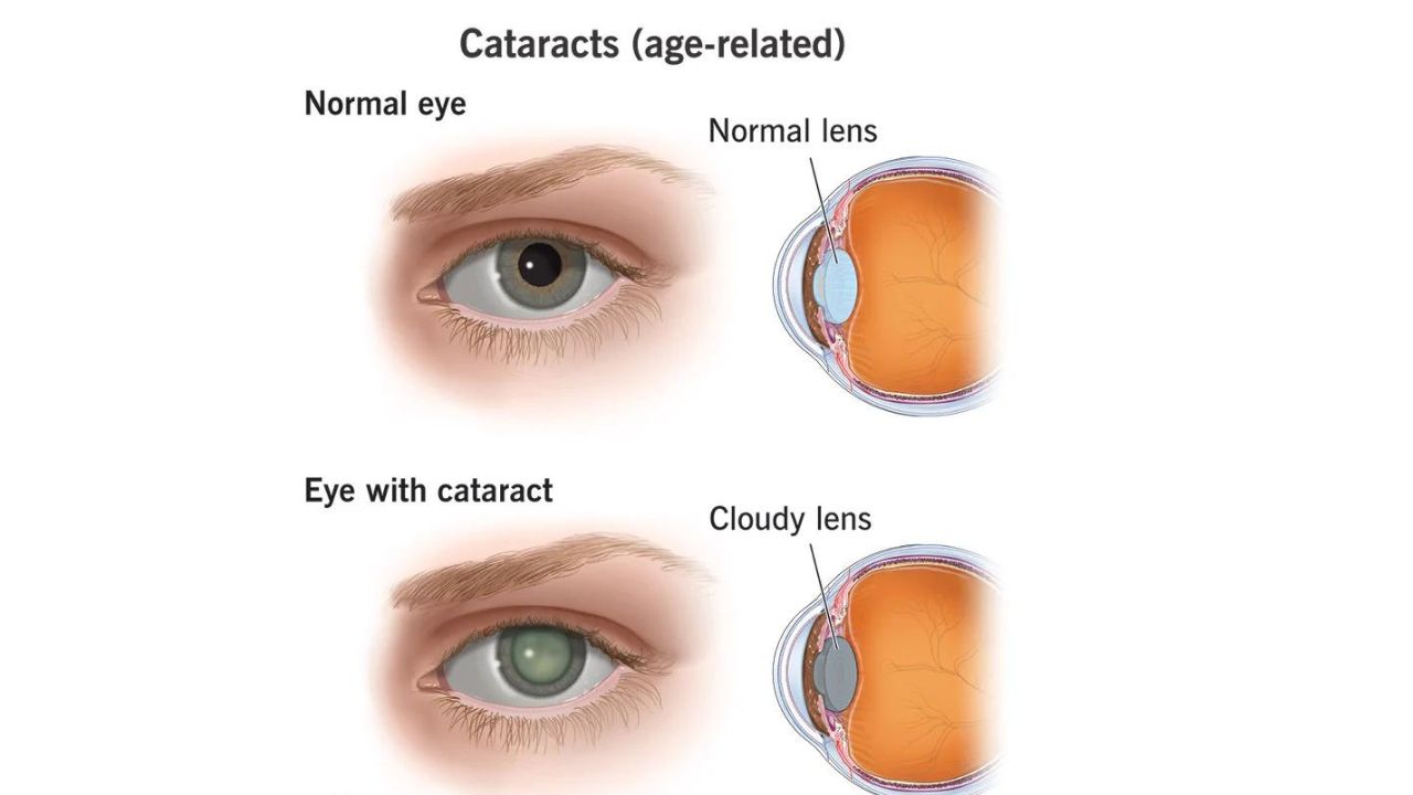 Cataract – Pump Industry